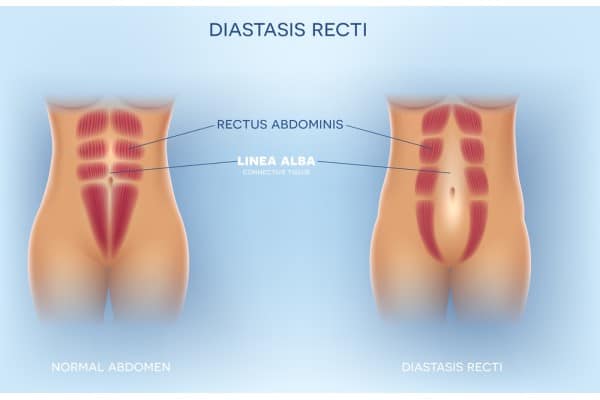 What Non-Surgical Options Are Available for Diastasis Recti Mansfield?