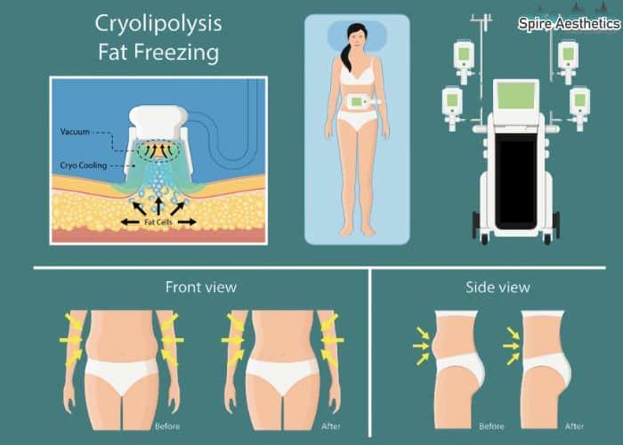 Image of diet and fat freezing combined for best results for Spire Aesthetics Mansfield