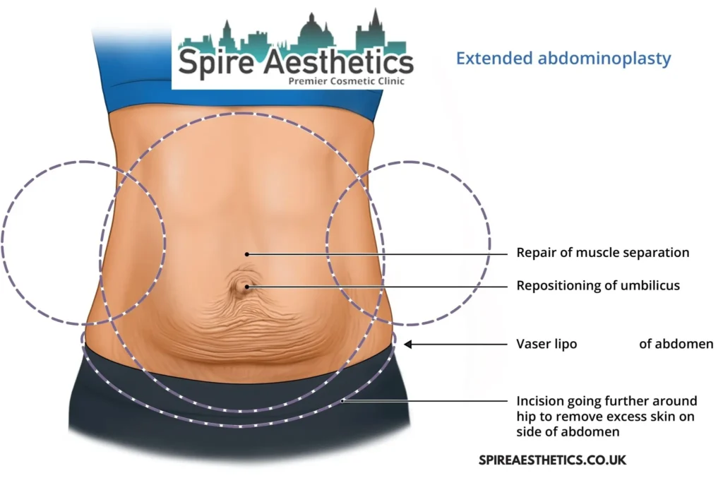 Understanding Loose Skin After Gastric Band Mansfield Surgery and HIFU Treatment
